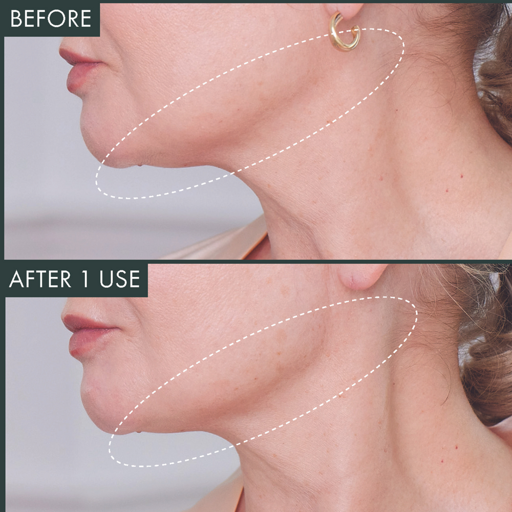 Fermitif Chin Mask Before & After