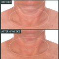 Fermitif Neck Renewal Night Cream / Firming Moisturizer Before & After