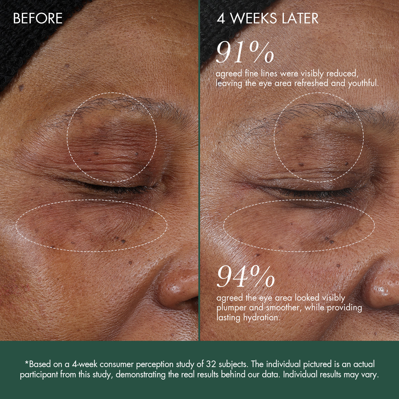 PAINLESS EYE-AREA PLUMPING